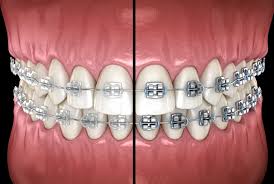 Orthodontic Treatments